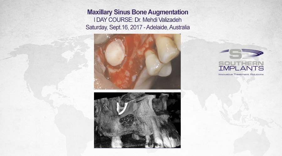 September 16, 2017 – Maxillary Sinus Bone Augmentation – Adelaide, Australia – Southern Implants Professional Education
