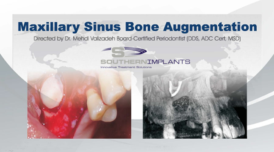 October 26 & 27, 2018 – Maxillary Sinus Bone Augmentation