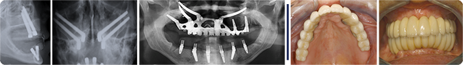 Severely atrophic Maxilla, treated successfully with “angulated implants”