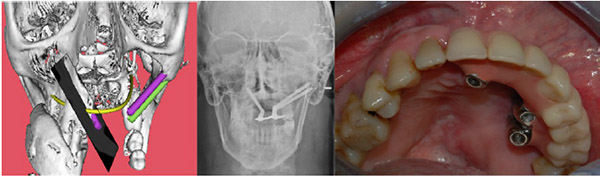 Computer Aided Implant Supported Rehabilitation of Atrophic/oncologic Patients Using Zygomatic Implants