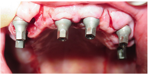 An Innovative Prefabricated Abutment Providing Customized Angular Connection (0-36o)