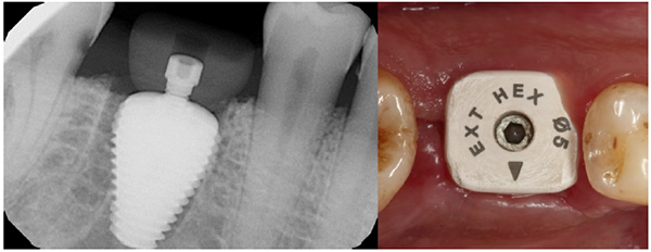 Guided Tissue Preservation: Case Report of a New Approach for Immediate Molar Replacement Using an Anatomically Shaped Implant and Healing Abutment