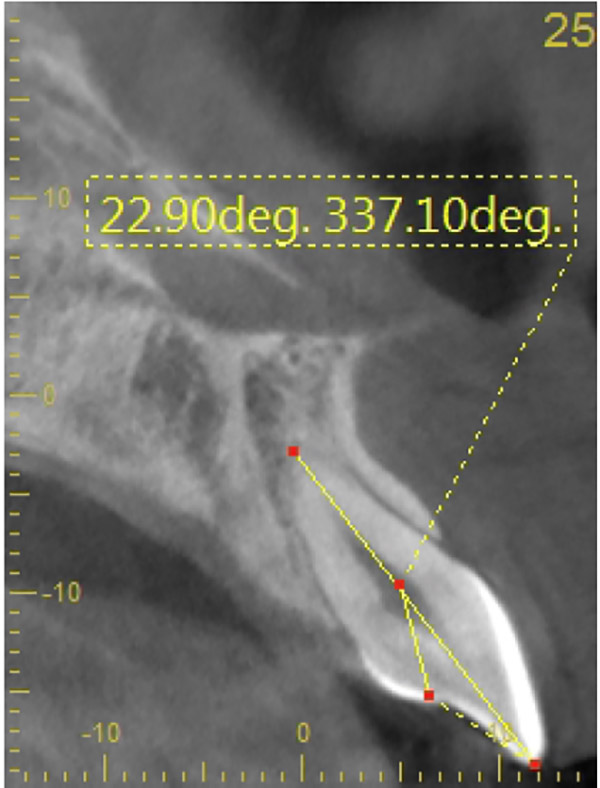 Angulation of Tooth Root Axis Relative to Planned Prosthetic Screw Axis in Central and Lateral Maxillary Incisors: A CT Study