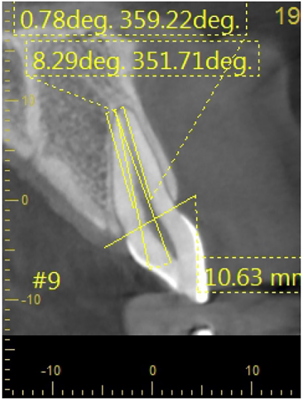 Angulation Between Planned Implant Axis and Ideal Screw Channel Axis in Maxillary Incisors: A CT Study