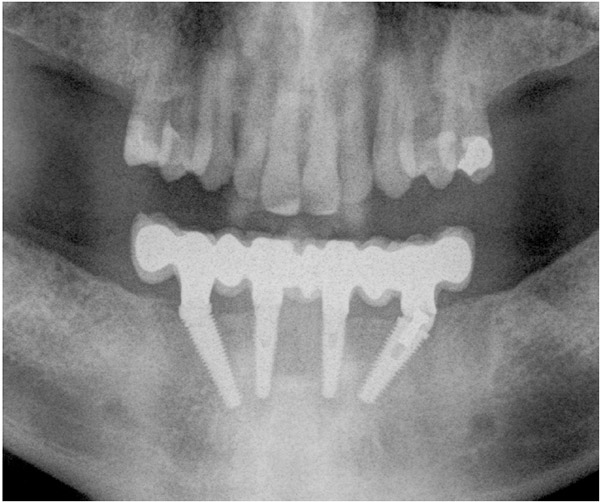 All-on-4 in the edentulous mandible: a tilted implant with angulated connection versus conventional implant with angulated abutment