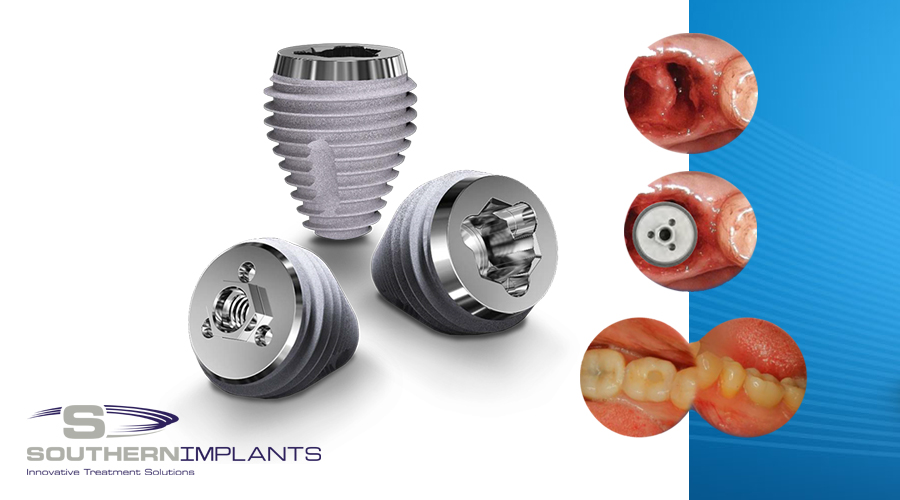 Dental Implants, Dental Education, Southern Implants Education, Dental Industry, SINA, Southern Implant, Southern Implants North America, Periodontists, Co Axis, Post Extraction Molar Tooth Replacement