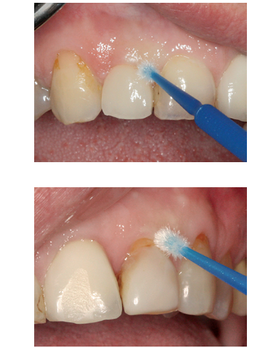 Peri Implantitis