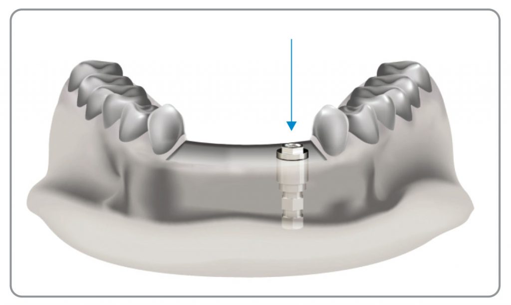 Digital Laboratory Analogues Southern Implants dental-technician-jobs-bahia-haha