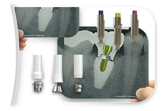 Prosthetics