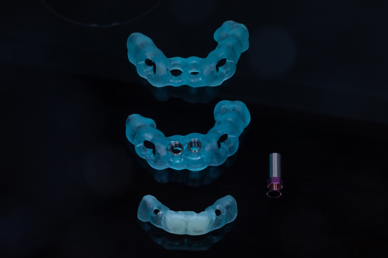 Definitive 4 unite fixed partial denture  in monolithic zirconia and passive abutment.