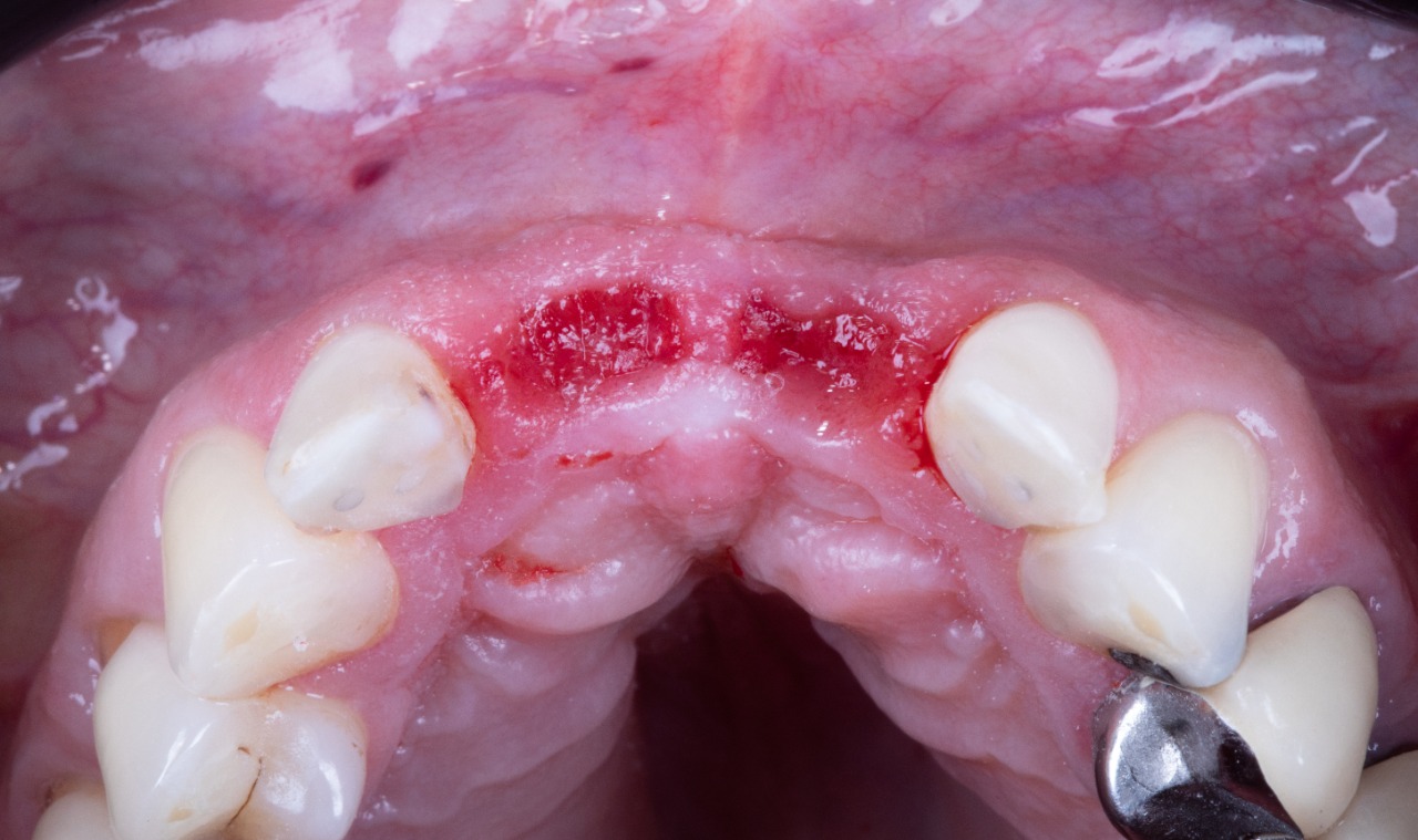 Definitive 4 unite fixed partial denture  in monolithic zirconia and passive abutment.