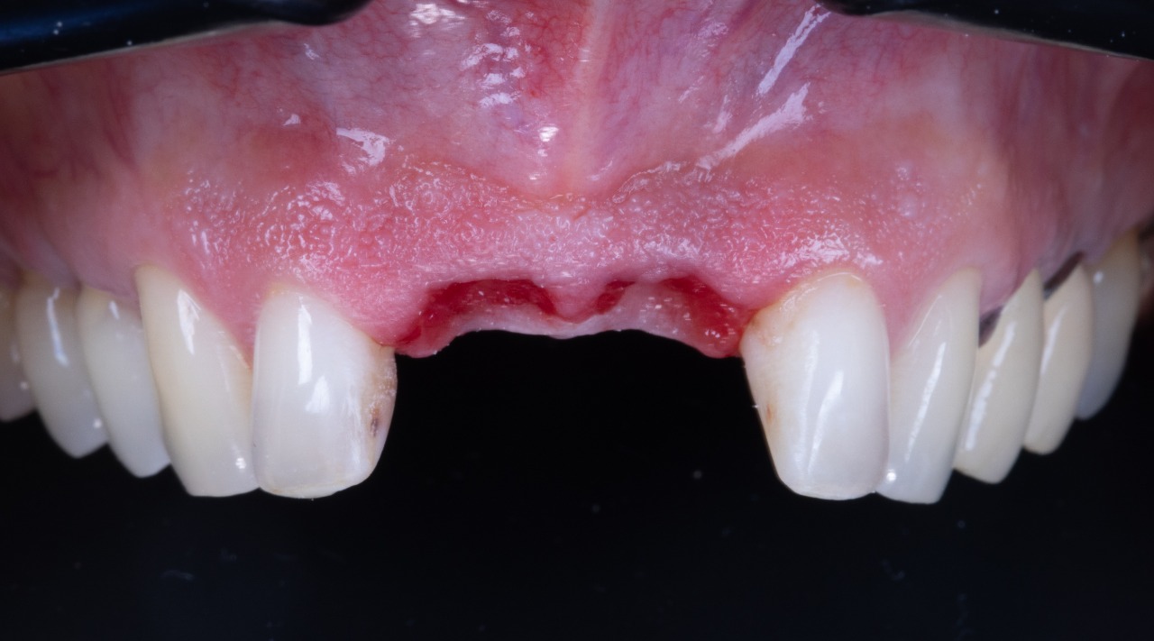 The definitive fixed partial denture in place. The restoration was tightened to 35 Ncm.