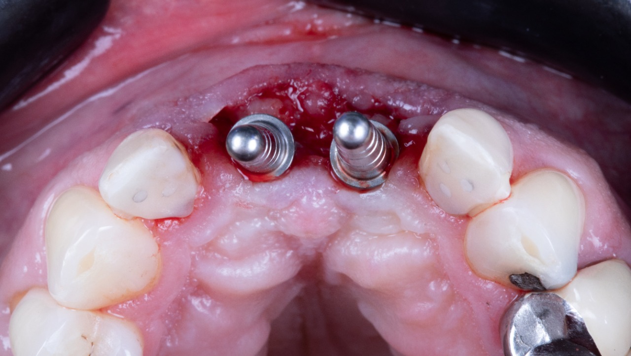 Definitive 4 unite fixed partial denture  in monolithic zirconia and passive abutment.