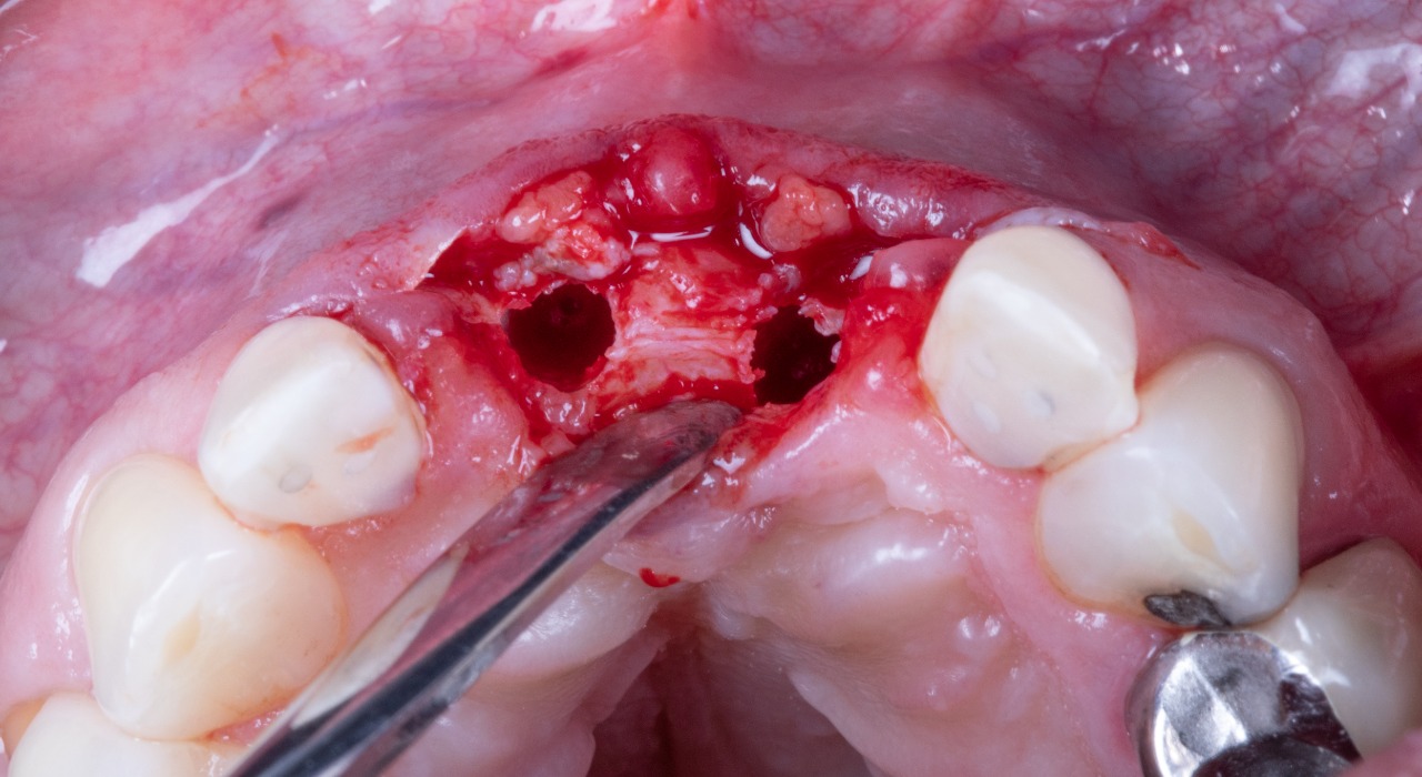 Definitive 4 unite fixed partial denture  in monolithic zirconia and passive abutment.