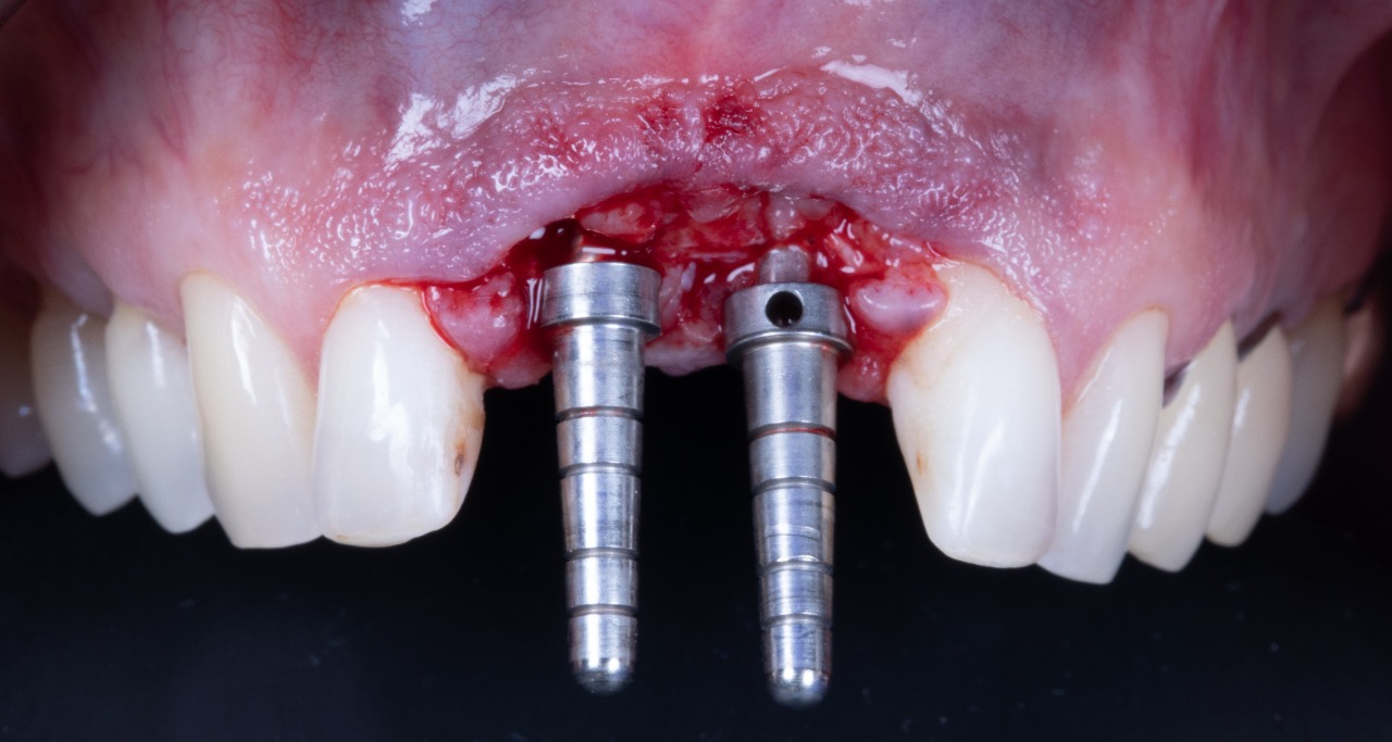 Definitive 4 unite fixed partial denture  in monolithic zirconia and passive abutment.