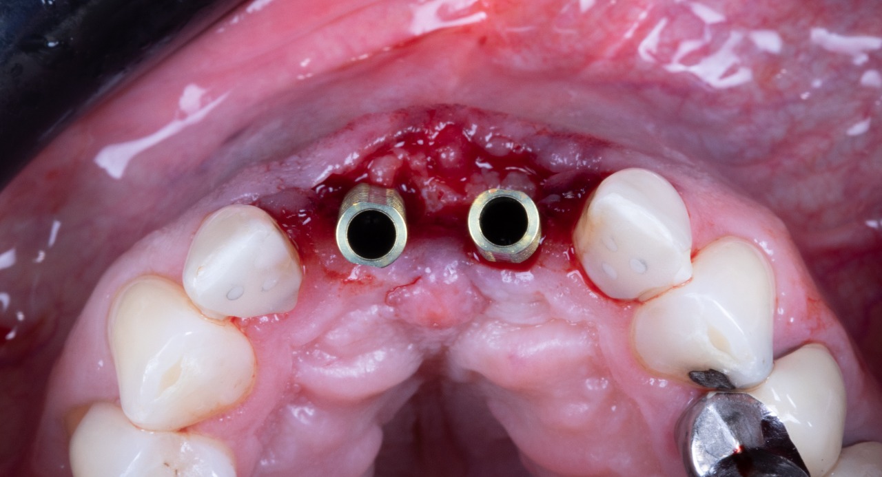 Definitive 4 unite fixed partial denture  in monolithic zirconia and passive abutment.