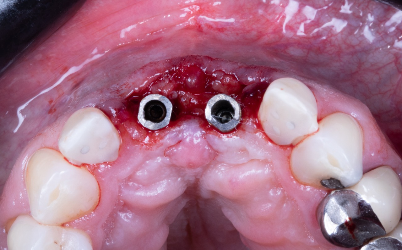 Definitive 4 unite fixed partial denture  in monolithic zirconia and passive abutment.