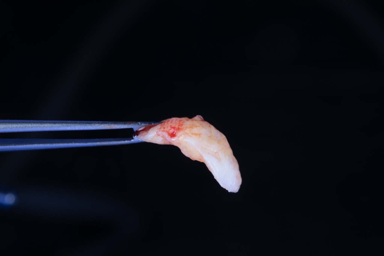 Definitive 4 unite fixed partial denture  in monolithic zirconia and passive abutment.