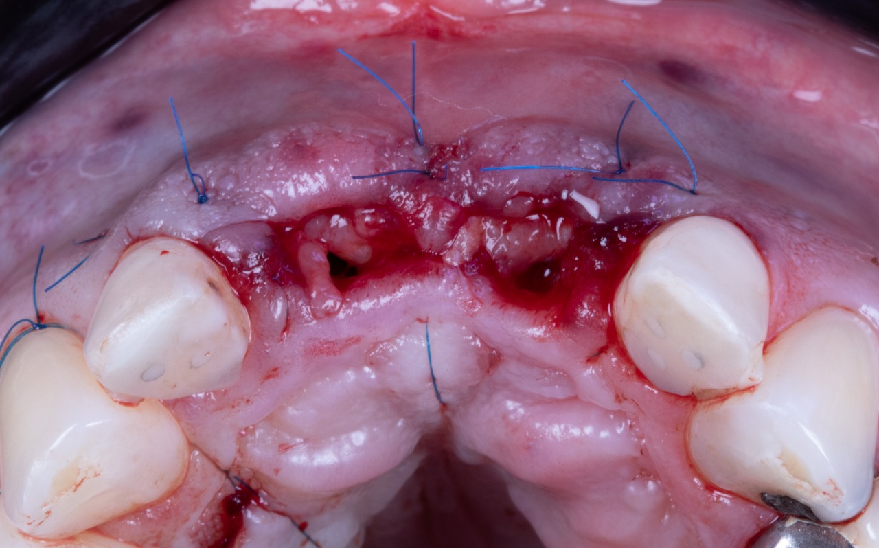 Definitive 4 unite fixed partial denture  in monolithic zirconia and passive abutment.